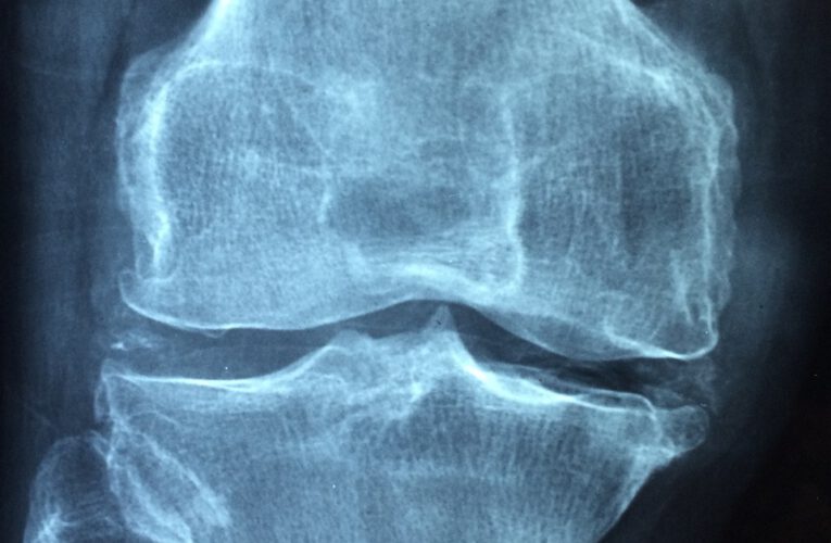Specjalistyczne Centrum Leczenia Osteoporozy: Nowoczesne Rozwiązania dla Twoich Kości